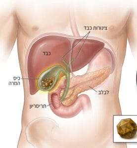 אבנים בכיס המרה - פרופסור רפי קרסו